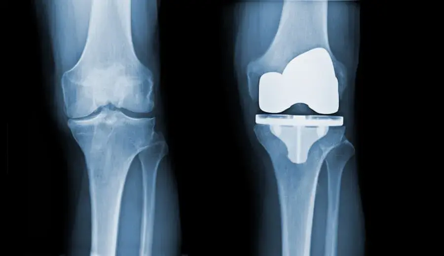 Total Knee Replacement Recovery: A Week-by-Week Guide