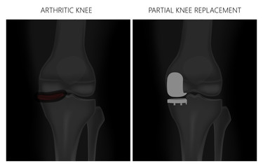 Arthritic Knee & Partial Knee Replacement